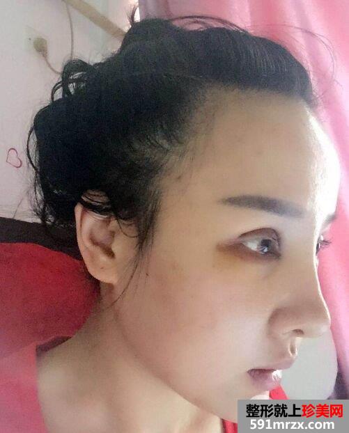  失败双眼皮修复+隆鼻修复手术对比照片，亲身经历分享