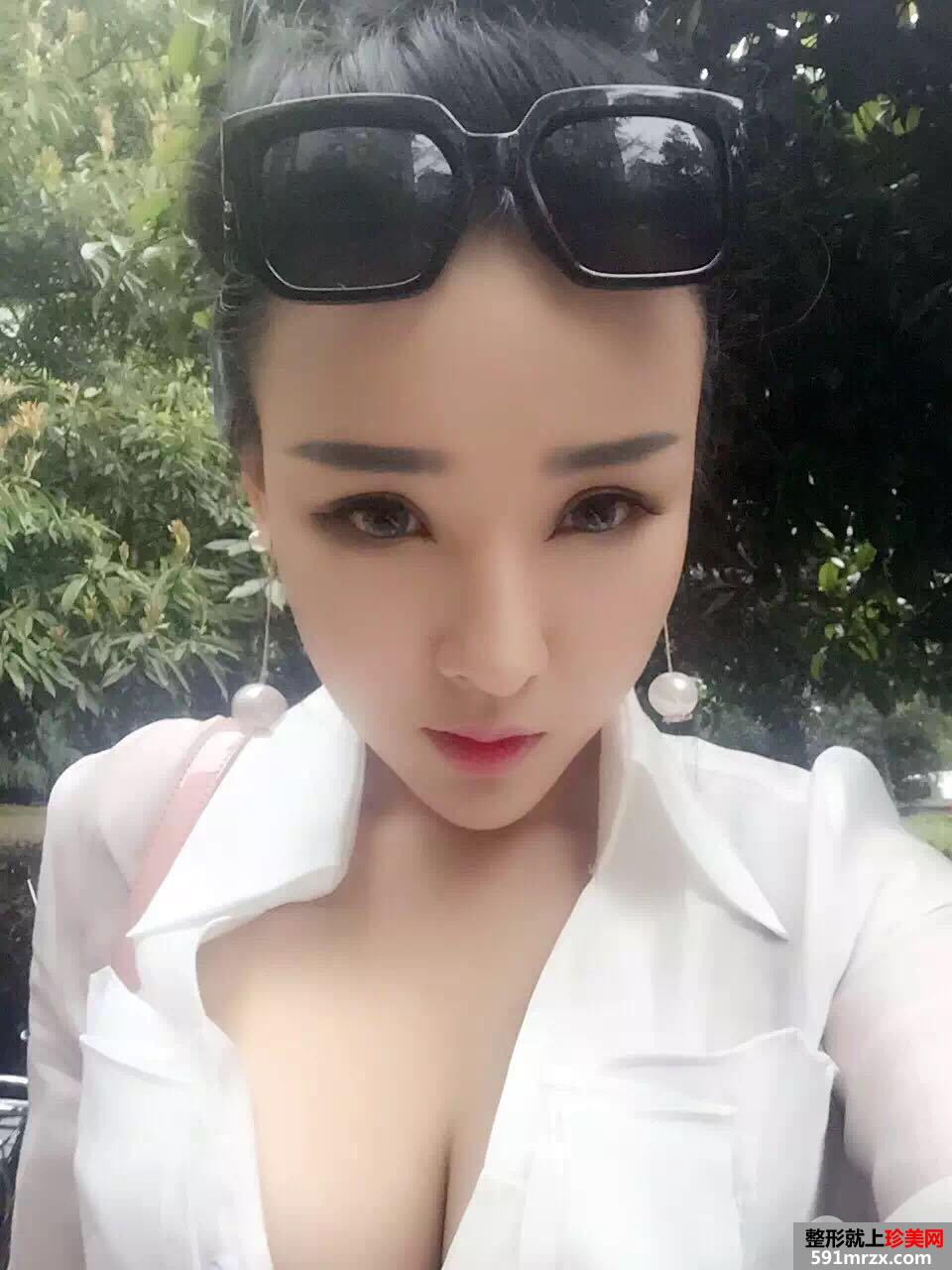  失败双眼皮修复+隆鼻修复手术对比照片，亲身经历分享