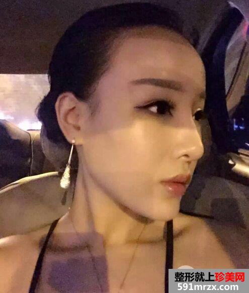  失败双眼皮修复+隆鼻修复手术对比照片，亲身经历分享