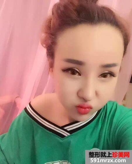  失败双眼皮修复+隆鼻修复手术对比照片，亲身经历分享