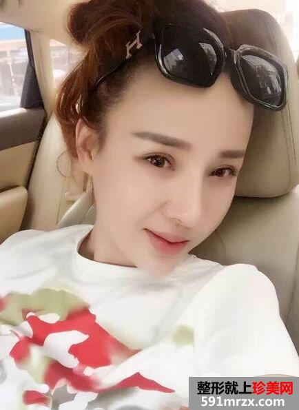  失败双眼皮修复+隆鼻修复手术对比照片，亲身经历分享