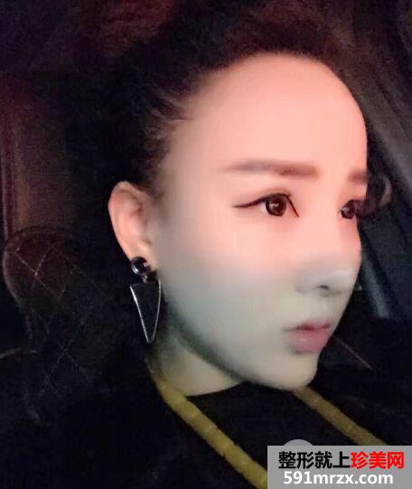  失败双眼皮修复+隆鼻修复手术对比照片，亲身经历分享