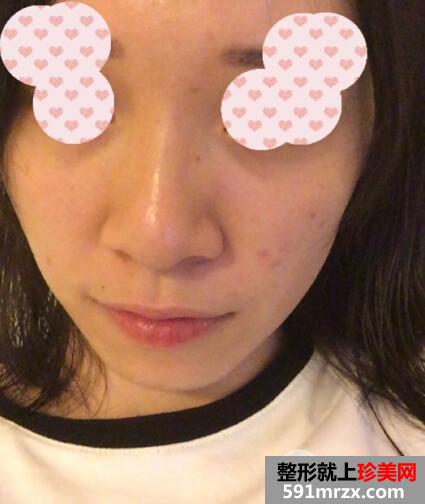 鼻翼过宽整容效果照片|鼻翼缩小亲身经历分享