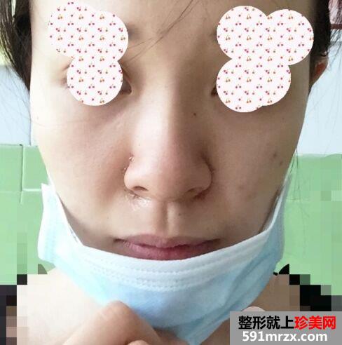 鼻翼过宽整容效果照片|鼻翼缩小亲身经历分享