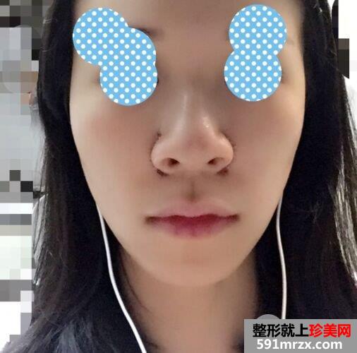 鼻翼过宽整容效果照片|鼻翼缩小亲身经历分享