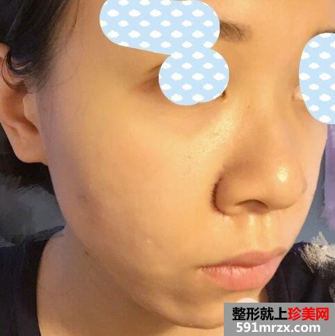鼻翼过宽整容效果照片|鼻翼缩小亲身经历分享
