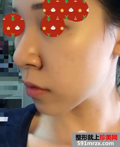 鼻翼过宽整容效果照片|鼻翼缩小亲身经历分享