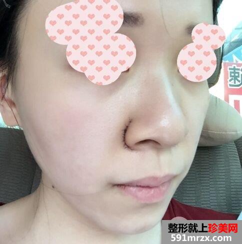 鼻翼过宽整容效果照片|鼻翼缩小亲身经历分享