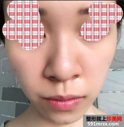 鼻翼过宽整容效果照片|鼻翼缩小亲身经历分享