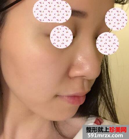 鼻翼过宽整容效果照片|鼻翼缩小亲身经历分享