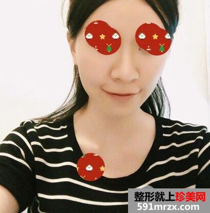 鼻翼过宽整容效果照片|鼻翼缩小亲身经历分享