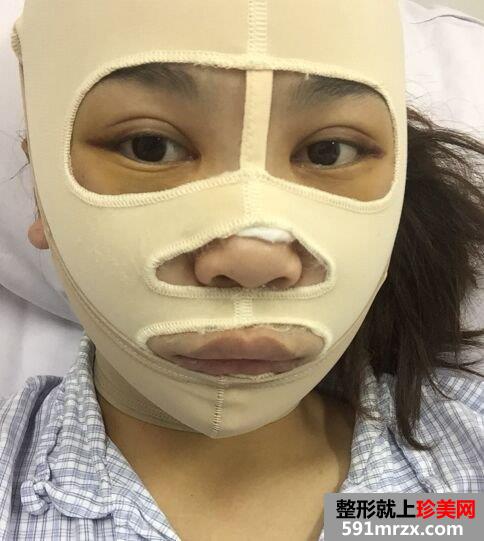 磨颧骨+磨下颌角手术过程分享，真实案例对比图