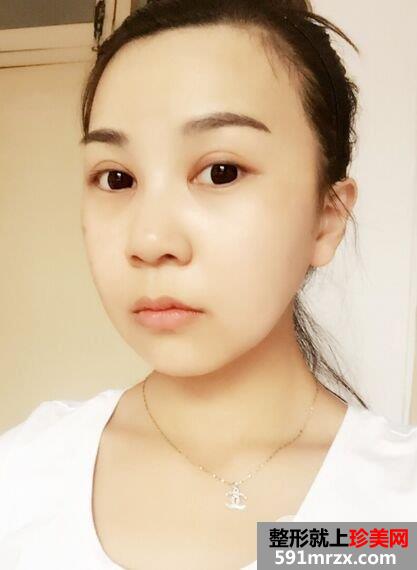 磨颧骨+磨下颌角手术过程分享，真实案例对比图
