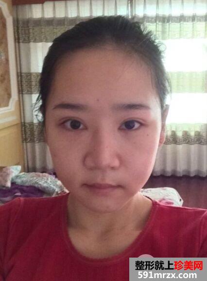 韩国双鄂手术恢复半年效果对比照真人案例分享，成功改脸型