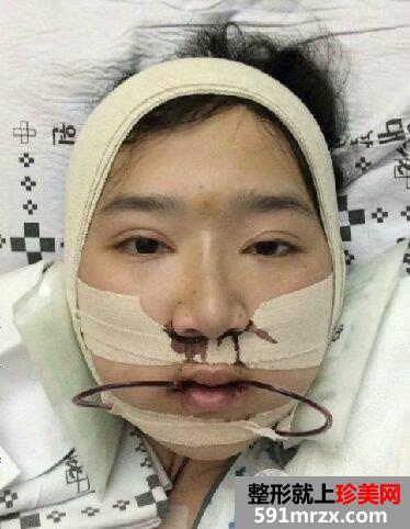 韩国双鄂手术恢复半年效果对比照真人案例分享，成功改脸型