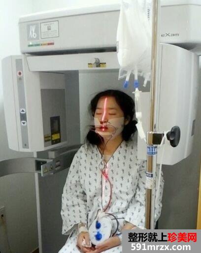 韩国双鄂手术恢复半年效果对比照真人案例分享，成功改脸型