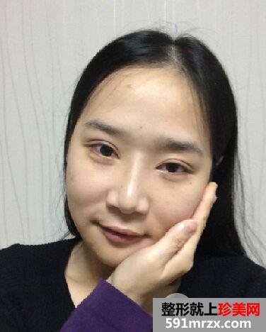 韩国双鄂手术恢复半年效果对比照真人案例分享，成功改脸型