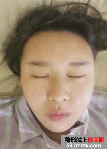 面部吸脂瘦脸效果案例对比图，立现精致小脸