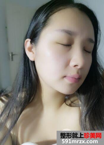 面部吸脂瘦脸效果案例对比图，立现精致小脸