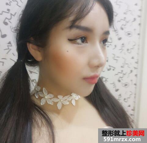 面部吸脂瘦脸效果案例对比图，立现精致小脸