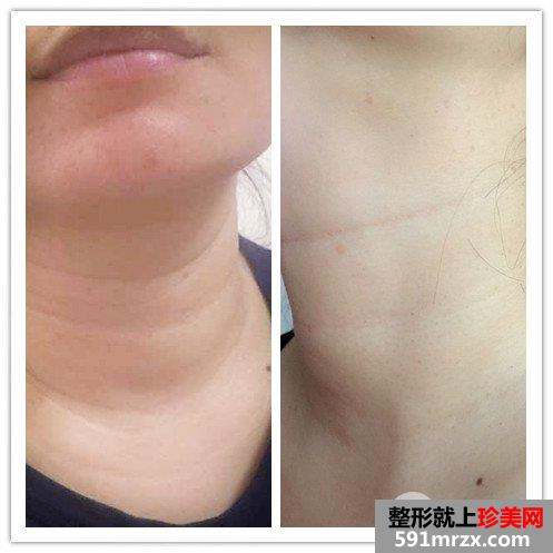 怎样去除颈纹|除皱针+超声刀去颈纹对比图案例分享