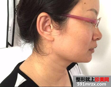 怎样去除颈纹|除皱针+超声刀去颈纹对比图案例分享