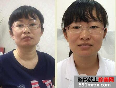 怎样去除颈纹|除皱针+超声刀去颈纹对比图案例分享