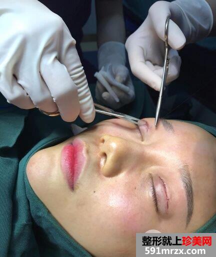 做双眼皮手术过程图详细介绍 血腥胆小勿入！
