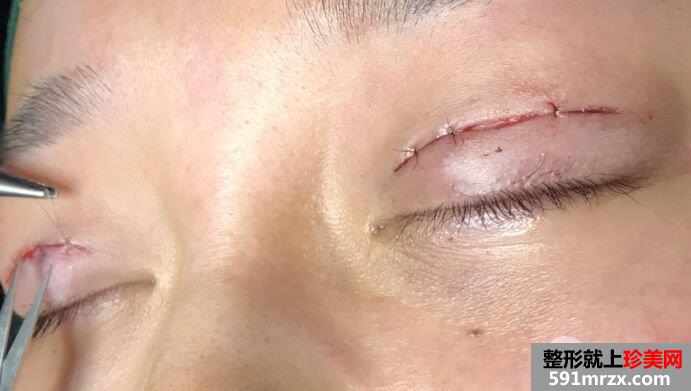 做双眼皮手术过程图详细介绍 血腥胆小勿入！