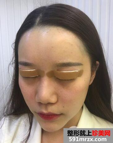 做双眼皮手术过程图详细介绍 血腥胆小勿入！