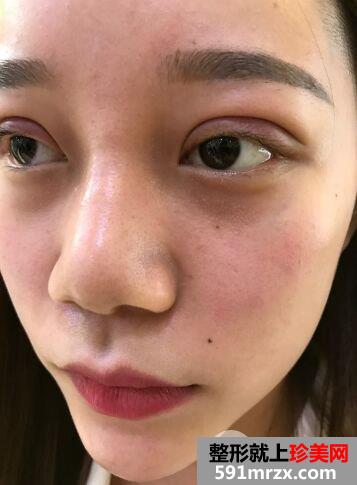 做双眼皮手术过程图详细介绍 血腥胆小勿入！