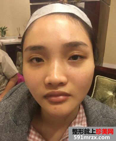 分享假体隆鼻+耳软骨垫鼻尖亲身经历，成功告别塌鼻子
