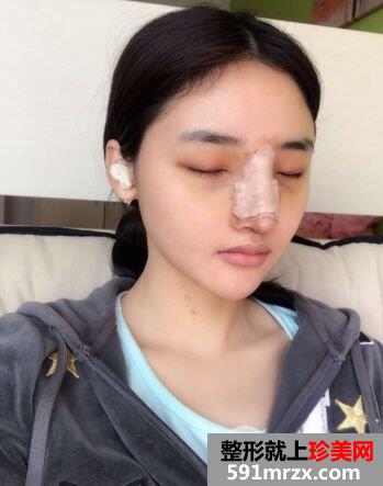 分享假体隆鼻+耳软骨垫鼻尖亲身经历，成功告别塌鼻子