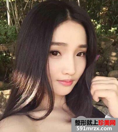 分享假体隆鼻+耳软骨垫鼻尖亲身经历，成功告别塌鼻子