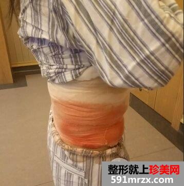 环形吸脂减肥瘦腰腹真实案例对比图，拥有小蛮腰
