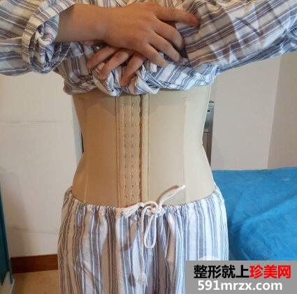 环形吸脂减肥瘦腰腹真实案例对比图，拥有小蛮腰