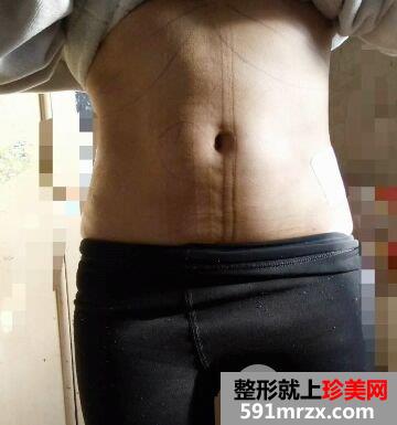 环形吸脂减肥瘦腰腹真实案例对比图，拥有小蛮腰