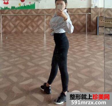 环形吸脂减肥瘦腰腹真实案例对比图，拥有小蛮腰