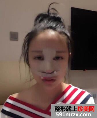 鼻综合整形|整鼻手术真人案例照片对比，轻松get小翘鼻