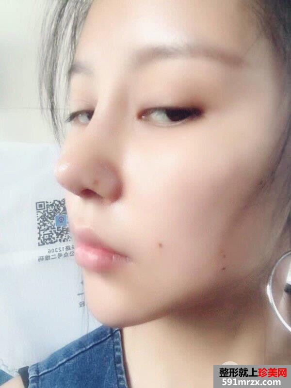 鼻综合整形|整鼻手术真人案例照片对比，轻松get小翘鼻