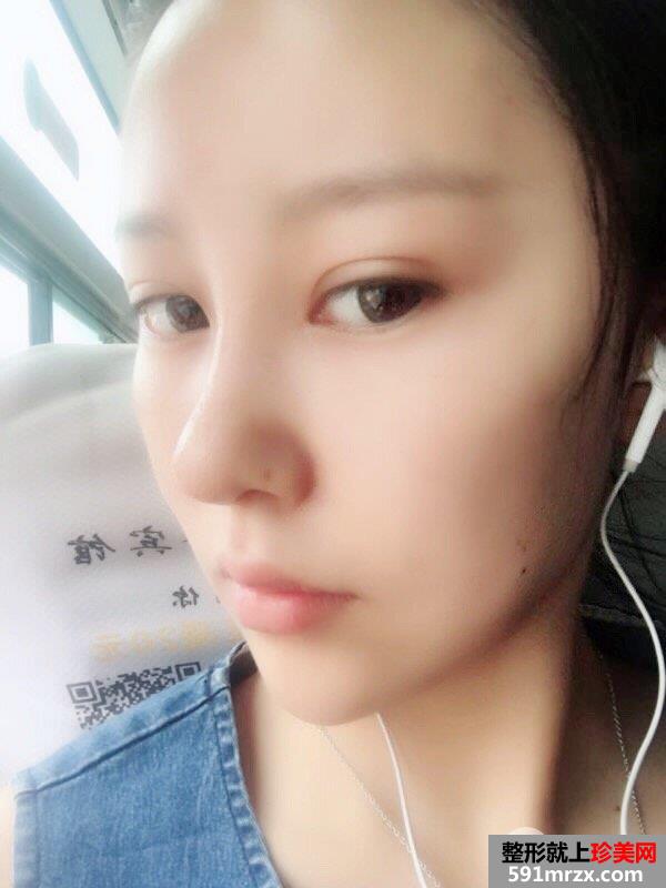 鼻综合整形|整鼻手术真人案例照片对比，轻松get小翘鼻