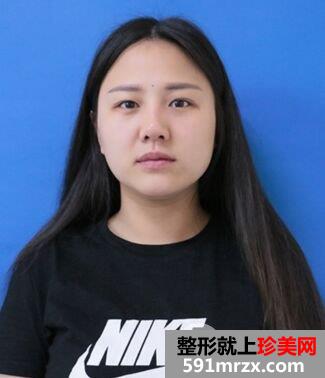 韩式肋骨隆鼻手术个人经历分享前后对比照片