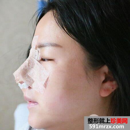 韩式肋骨隆鼻手术个人经历分享前后对比照片