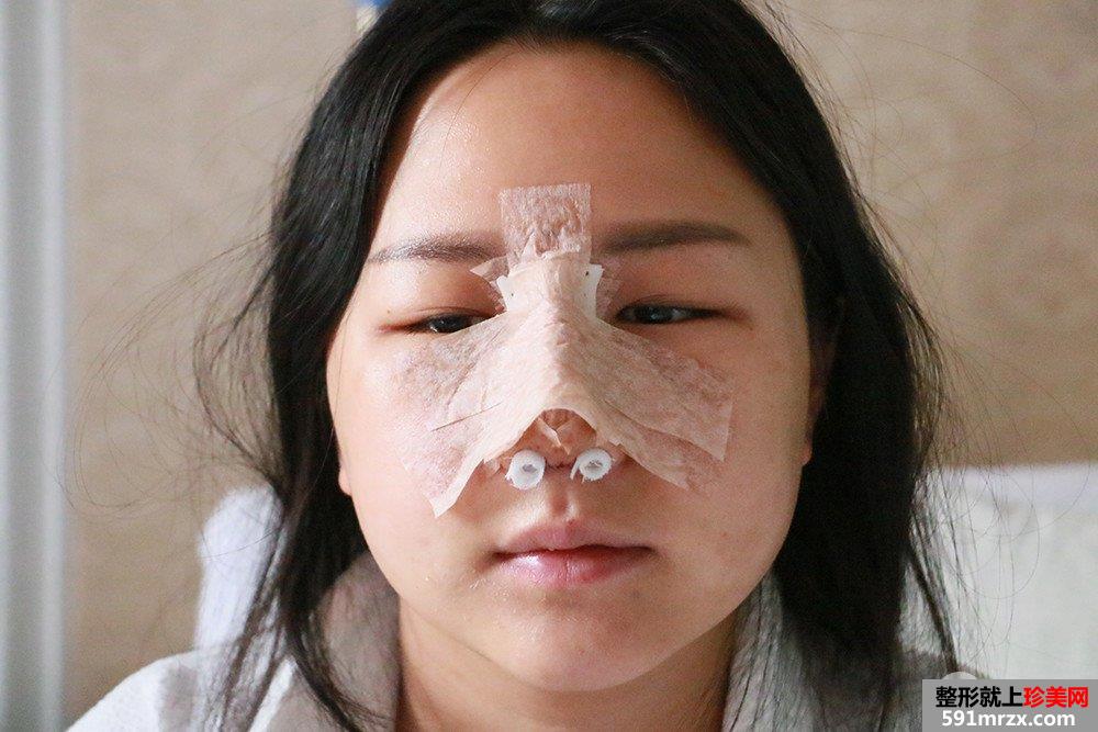 韩式肋骨隆鼻手术个人经历分享前后对比照片