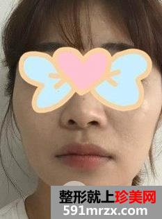 颧骨内推+磨下颌角手术亲身经历两个月恢复对比图
