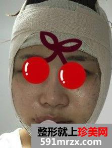 颧骨内推+磨下颌角手术亲身经历两个月恢复对比图