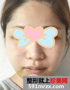 颧骨内推+磨下颌角手术亲身经历两个月恢复对比图
