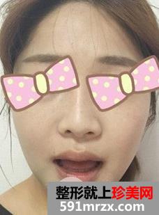 颧骨内推+磨下颌角手术亲身经历两个月恢复对比图