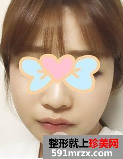 颧骨内推+磨下颌角手术亲身经历两个月恢复对比图