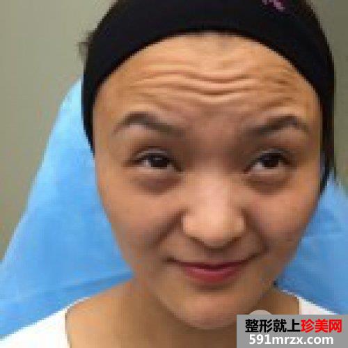 注射去皱纹|去抬头纹对比照片真实案例分享